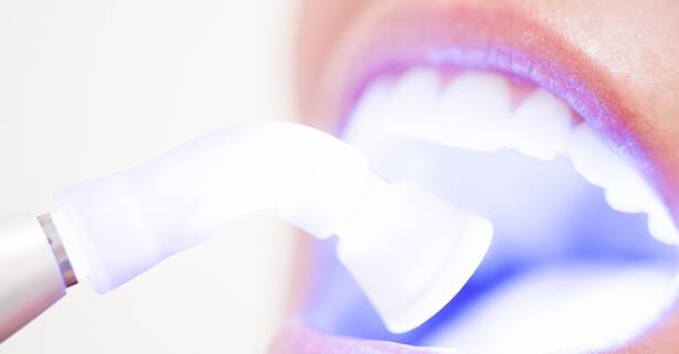 Limpieza bucal y blanqueamiento
