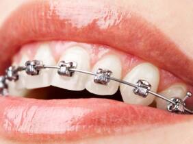 Ortodoncia con brackets
