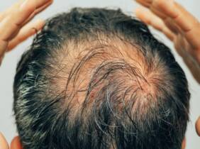 Madrid Revitaliza tu cabello con mesoterapia avanzada para un look saludable