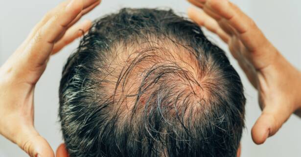 Madrid Revitaliza tu cabello con mesoterapia avanzada para un look saludable