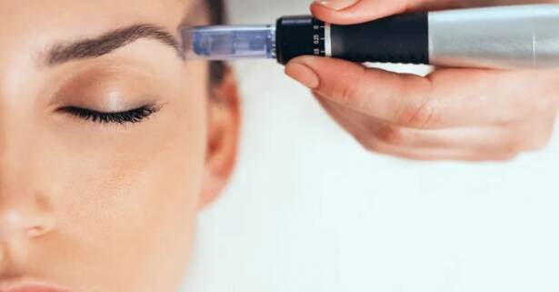 Granada Exosomas con dermapen en rostro completo