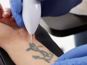 A Coruña Eliminación de tatuajes