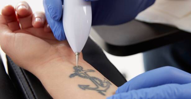 A Coruña Eliminación de tatuajes