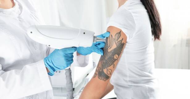 Valencia 3 o 6 sesiones de eliminación de tatuaje de hasta 10 x 10 cm para 1