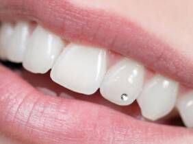 Zaragoza Colocación de 1 o 2 brillantes dentales no invasivos para 1 persona