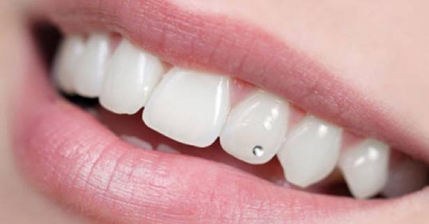 Zaragoza Colocación de 1 o 2 brillantes dentales no invasivos para 1 persona