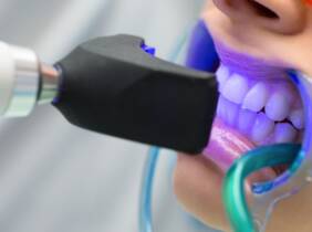 Málaga 1 o 2 sesiones de blanqueamiento y limpieza bucal con fluoración
