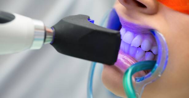 Málaga 1 o 2 sesiones de blanqueamiento y limpieza bucal con fluoración