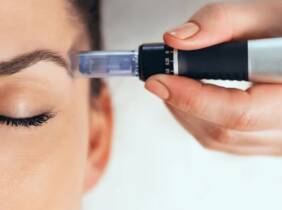 Madrid Hasta 3 sesiones de microlifting facial de vitaminas con Dermapen