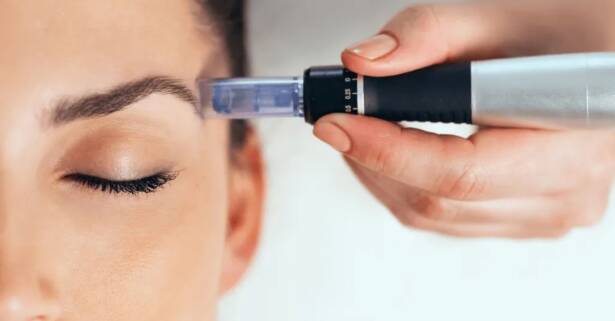 Madrid Hasta 3 sesiones de microlifting facial de vitaminas con Dermapen