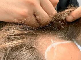 Barcelona Trasplante de microinjerto capilar FUE en Medical Esthetic Group