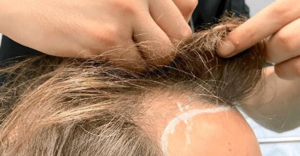 Barcelona Trasplante de microinjerto capilar FUE en Medical Esthetic Group