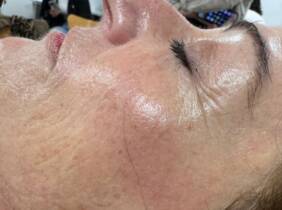 Madrid 1 o 2 sesiones de exosomas con dermapen en 2 fases en rostro completo