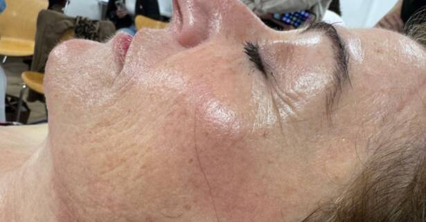 Madrid 1 o 2 sesiones de exosomas con dermapen en 2 fases en rostro completo