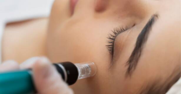 Tarragona Microneedling facial o corporal
