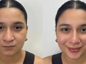 Madrid 1 o 3 sesiones de mesoterapia facial inyectada