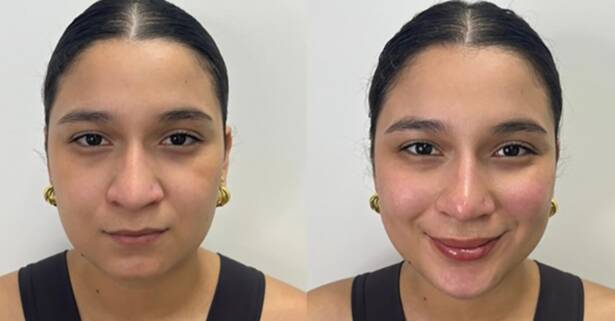 Madrid 1 o 3 sesiones de mesoterapia facial inyectada