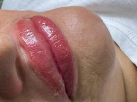 Madrid Hidratación de labios efecto volumen con hyaluron pen