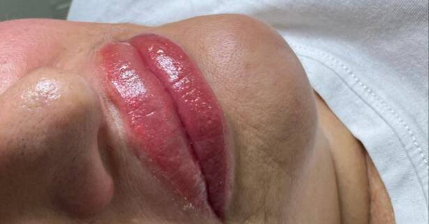 Madrid Hidratación de labios efecto volumen con hyaluron pen