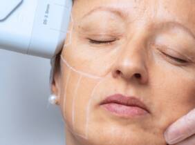Alicante Tratamiento facial HIFU
