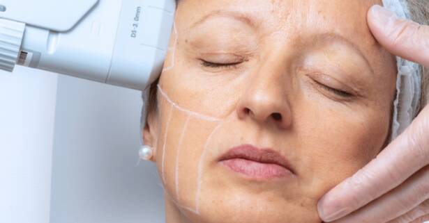 Alicante Tratamiento facial HIFU