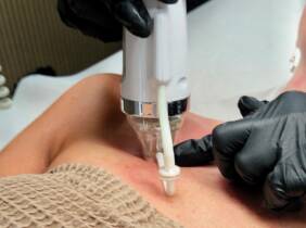Tenerife Tratamiento facial - Peeling