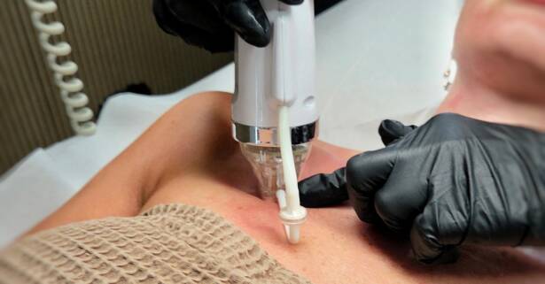 Tenerife Tratamiento facial - Peeling
