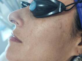 Madrid 1 o 2 sesiones de fotorejuvenecimiento facial con láser IPL para 1