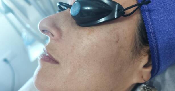 Madrid 1 o 2 sesiones de fotorejuvenecimiento facial con láser IPL para 1