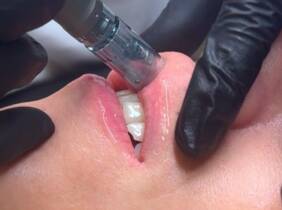 Madrid Sesión de rehidratación de labios con dermapen y vitaminas para 1