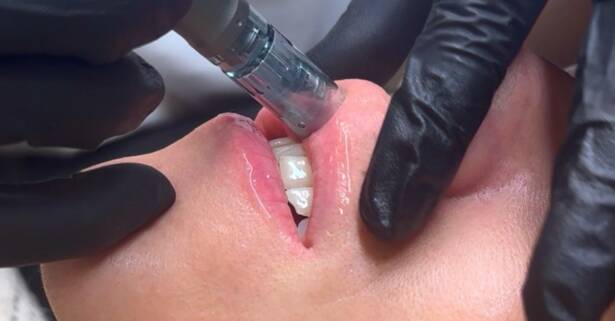 Madrid Sesión de rehidratación de labios con dermapen y vitaminas para 1