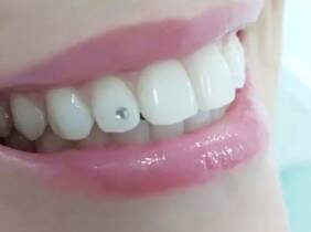 Madrid Limpieza dental con ultrasonidos y opción a 1 o 2 brillantes dentales