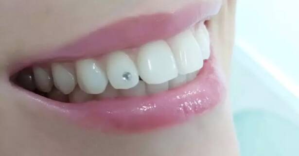 Madrid Limpieza dental con ultrasonidos y opción a 1 o 2 brillantes dentales