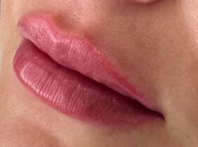 Madrid Relleno dérmico para labios: 1 o 2 viales para un resultado natural