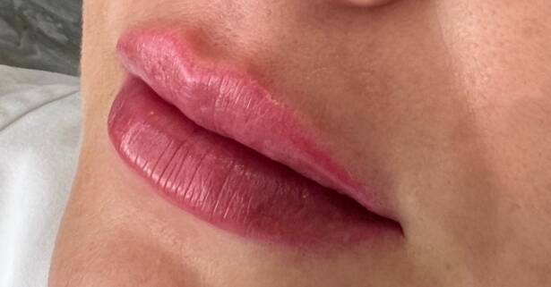 Madrid Relleno dérmico para labios: 1 o 2 viales para un resultado natural