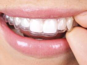 Zaragoza Limpieza bucal con férula en Clínica Dental Gonzalo de Berceo