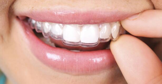 Zaragoza Limpieza bucal con férula en Clínica Dental Gonzalo de Berceo