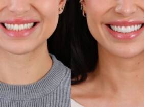 Barcelona Hasta 4 carillas dentales de composite o cerámica