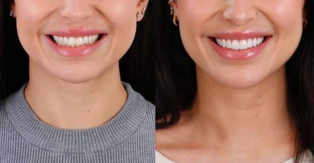 Barcelona Hasta 4 carillas dentales de composite o cerámica