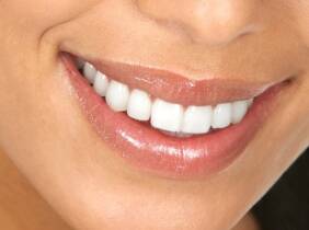 Valencia Blanqueamiento dental en la clínica estética dental Clesdent