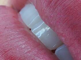 Madrid Micropigmentación de labios y opción a labios oscuros con exfoliación
