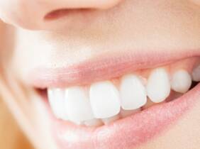 Madrid Blanqueamiento dental - Tradicio