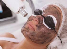Madrid Tratamiento facial Hollywood Peel con carbón y/o principio activo