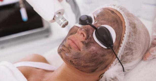 Madrid Tratamiento facial Hollywood Peel con carbón y/o principio activo