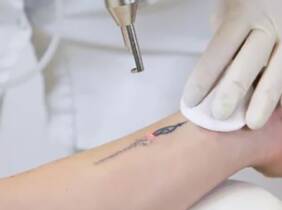 Alicante Sesiones de eliminación de tatuajes en zona a elegir