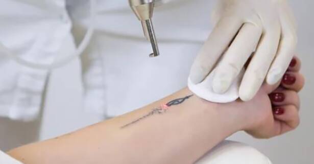Alicante Sesiones de eliminación de tatuajes en zona a elegir